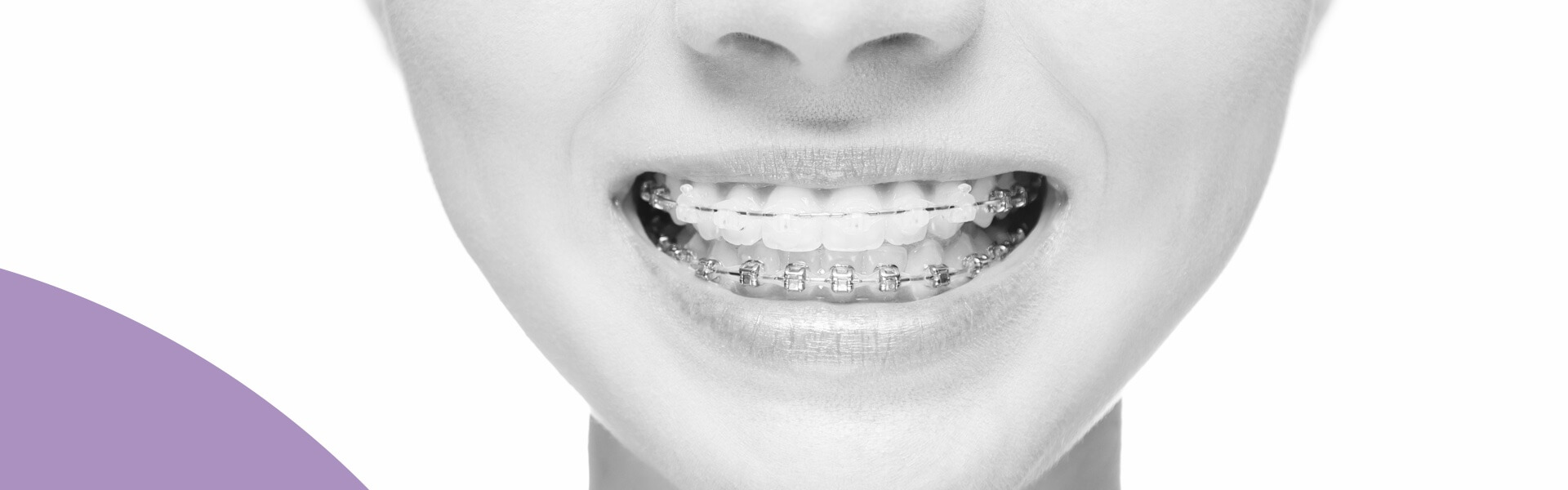 Frau mit Zahnspange im Rahmen der Kieferorthopädie Bern